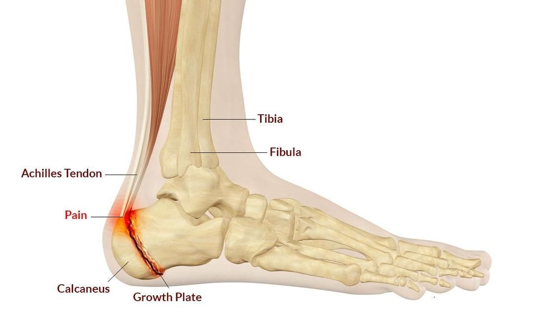 Achilles Tendinitis