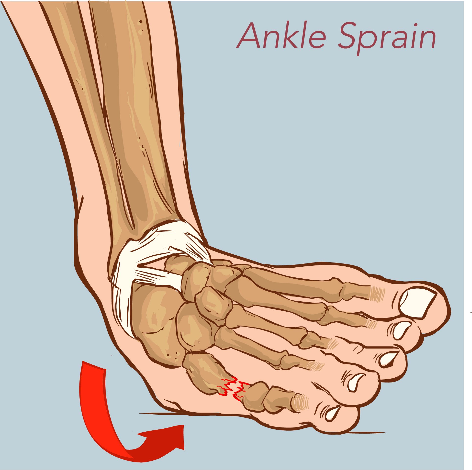Ankle Sprains