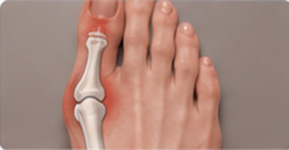 Gout