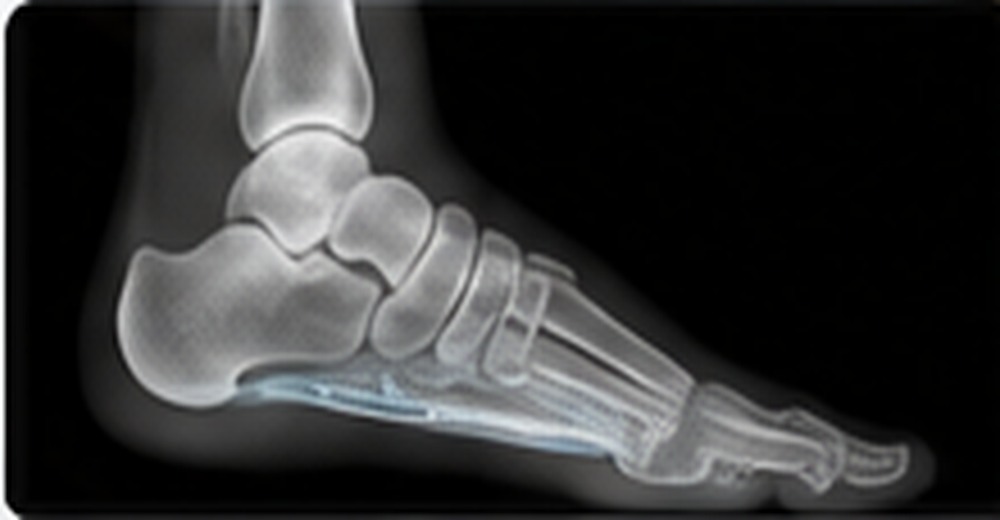 Flat Feet (Pes Planus)