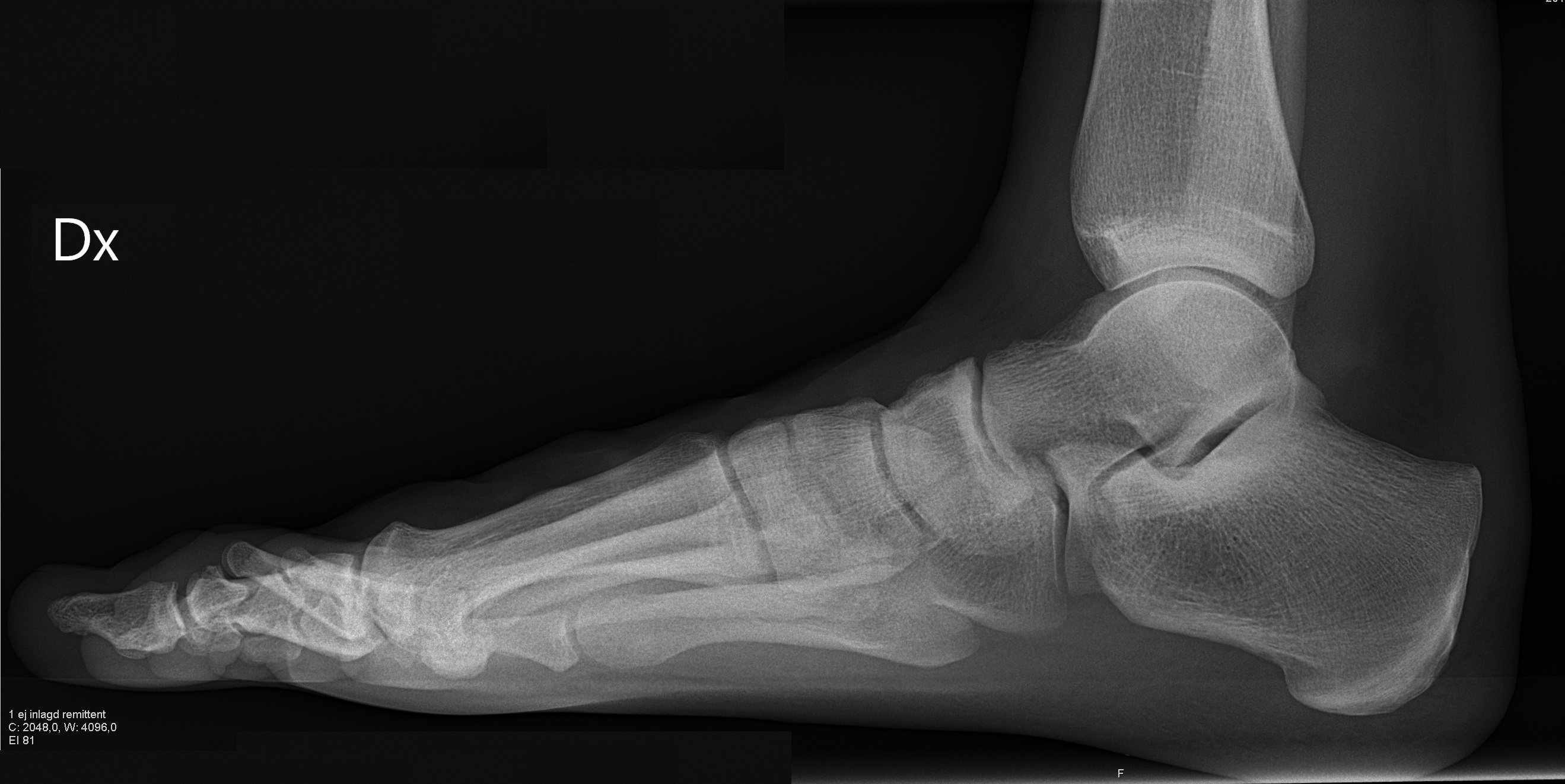 High Arches (Pes Cavus)